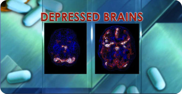 Depression Brain Scans